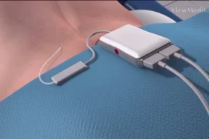 Breakthrough device helps patients with chronic back pain